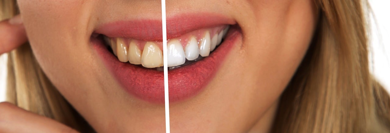 Teeth Whitening Treatment | Healthy Dental Crown Process | Star Dental | Dental Wellness