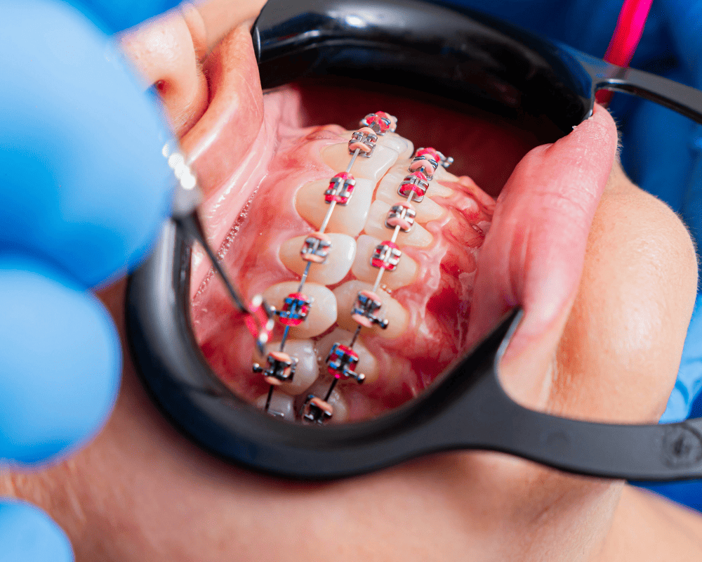 Braces Treatment | Star Dental | Healthy Dental Crown Process | Star Dental | Dental Wellness