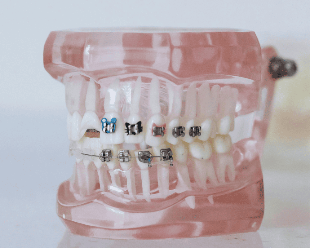 Braces Treatment at The Star Dental | Healthy Dental Crown Process | Star Dental | Dental Wellness