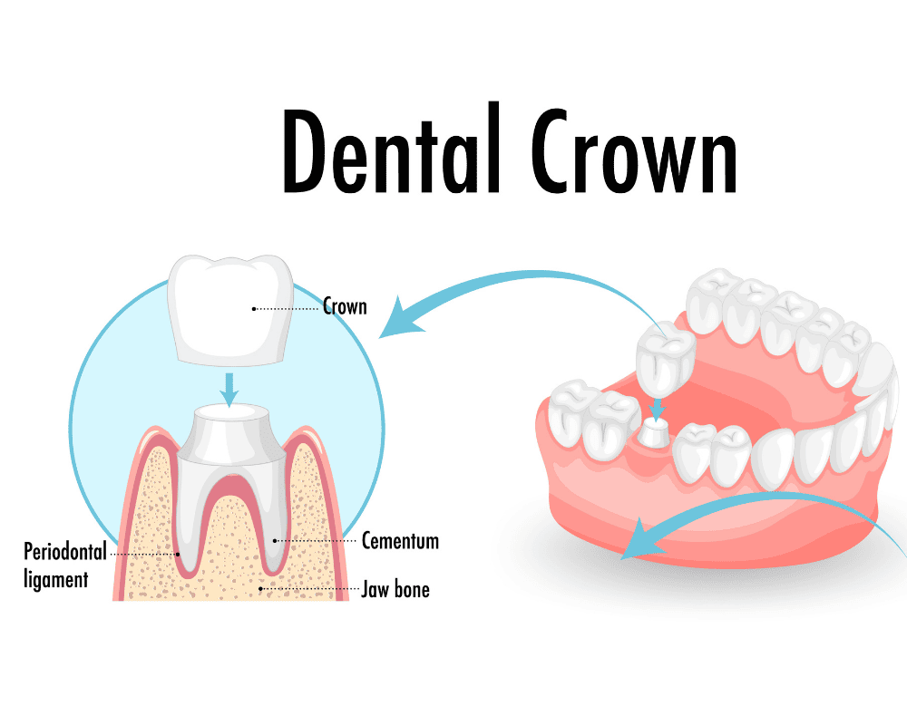 Dental Crown Treatment at The Star Dental