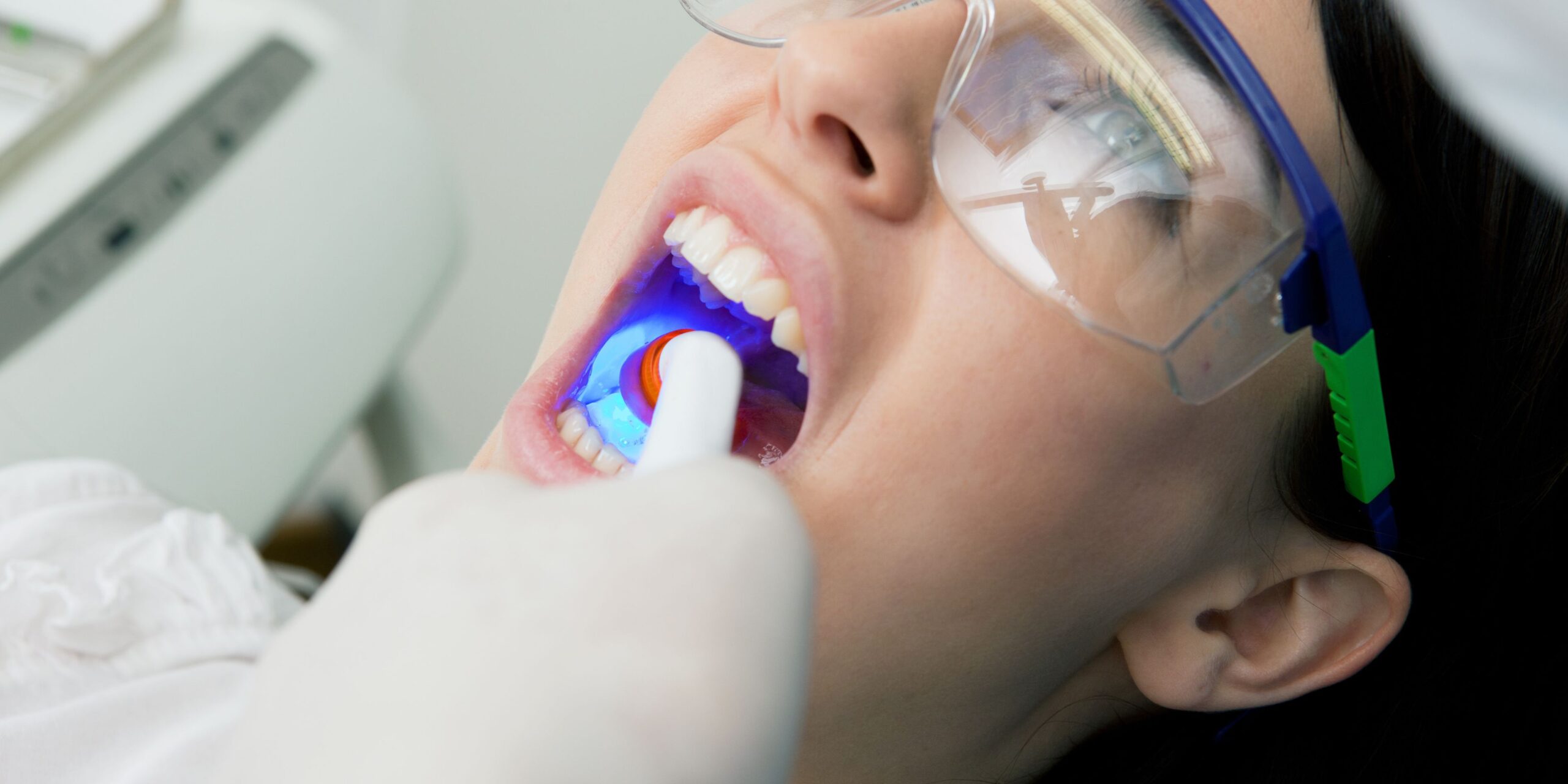 Dental Filling Lasts Longer