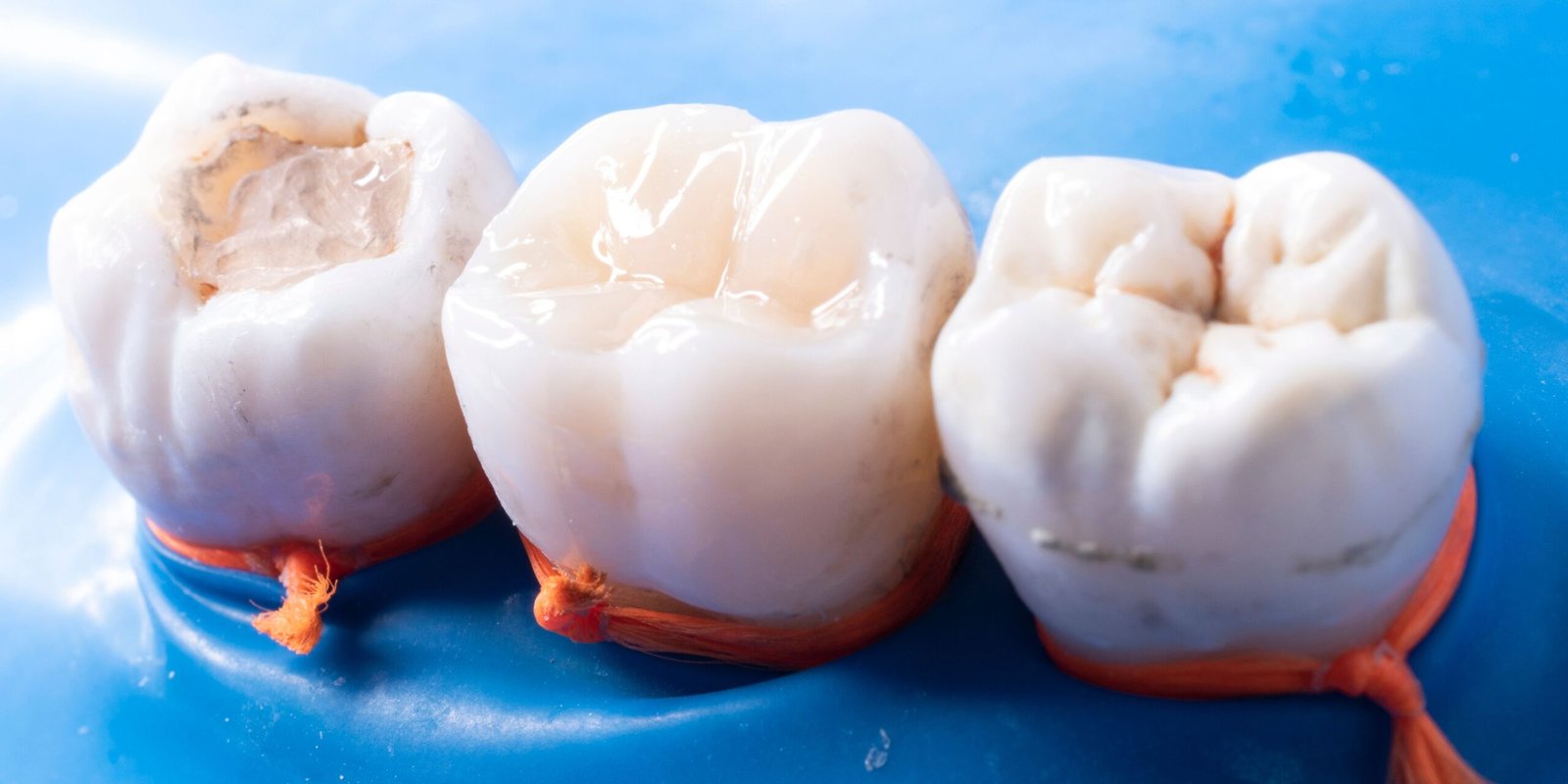 White Composite Fillings_