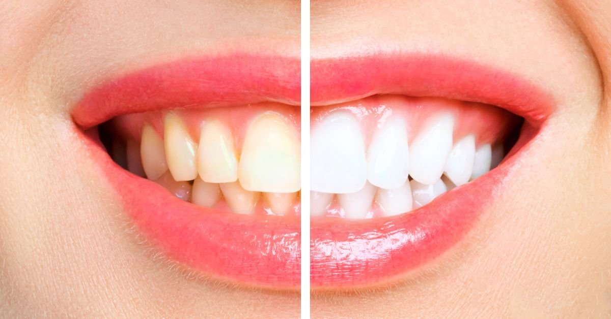 Best Teeth Whitening in Calgary