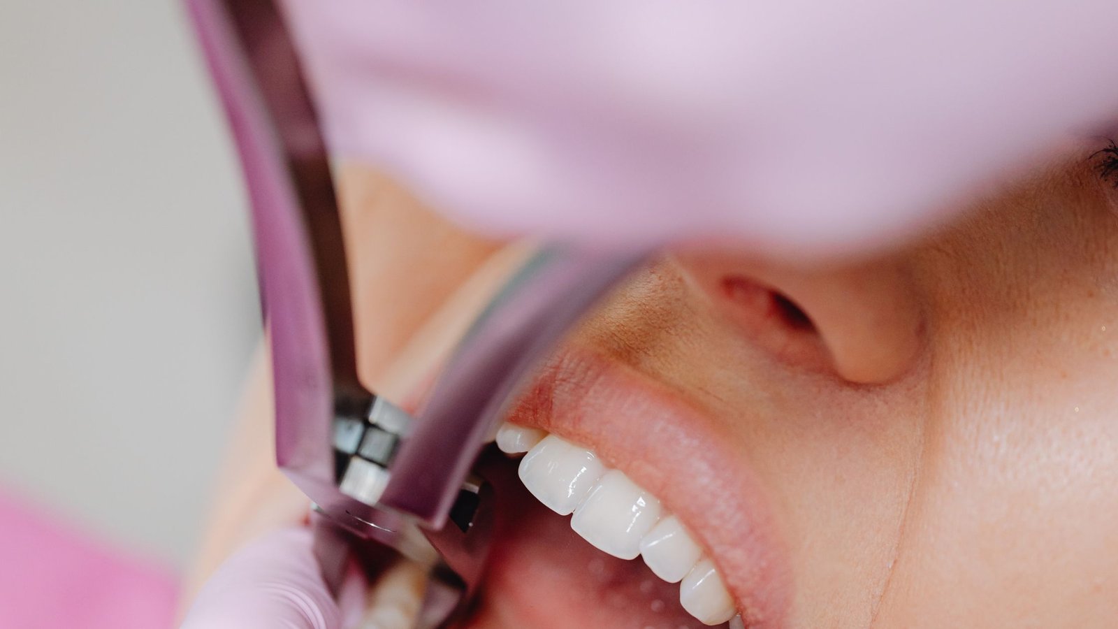 Best Tooth Extraction