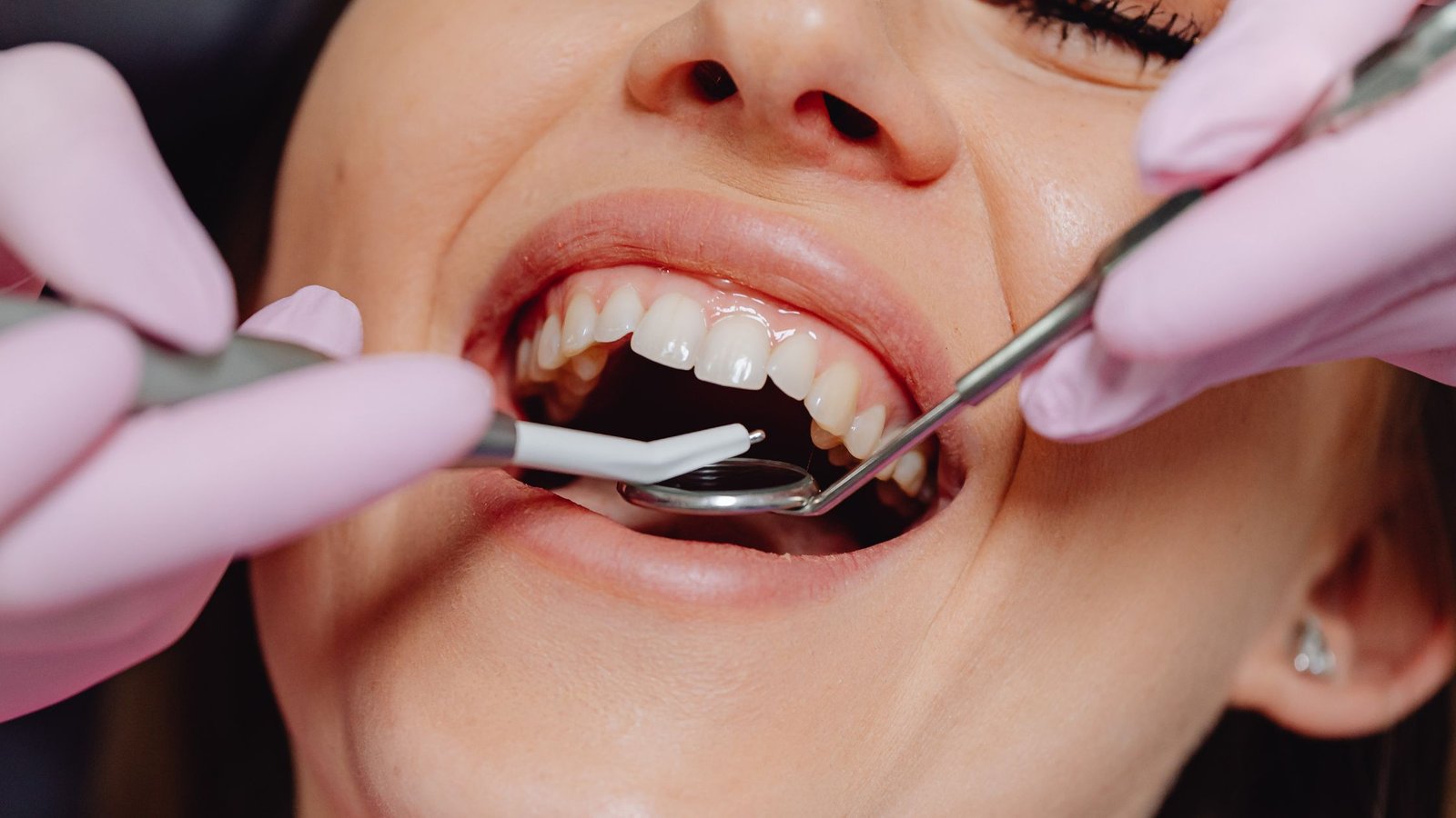 Best Tooth Extraction