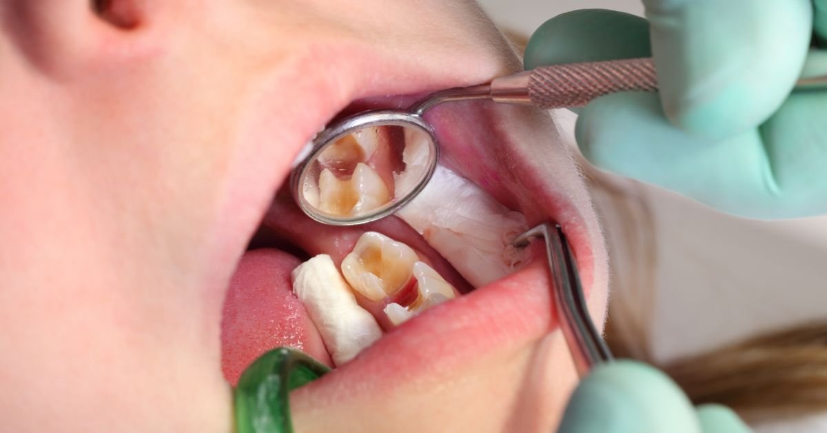 Dental Filling 