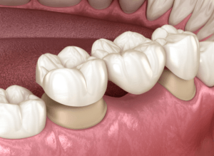 Dental Bridges